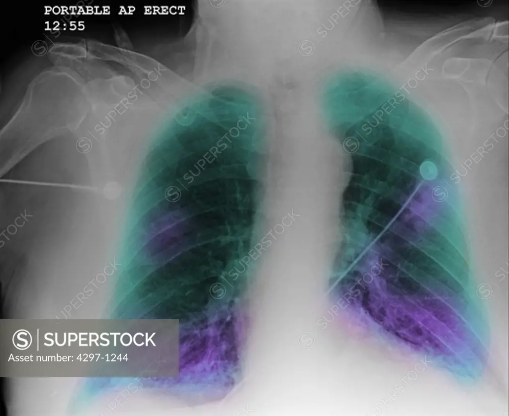 Chest x-ray of a 76 year old man with COPD, chronic obstructive pulmonary disease, Chest x-ray of a 76 year old man with a history of smoking and COPD