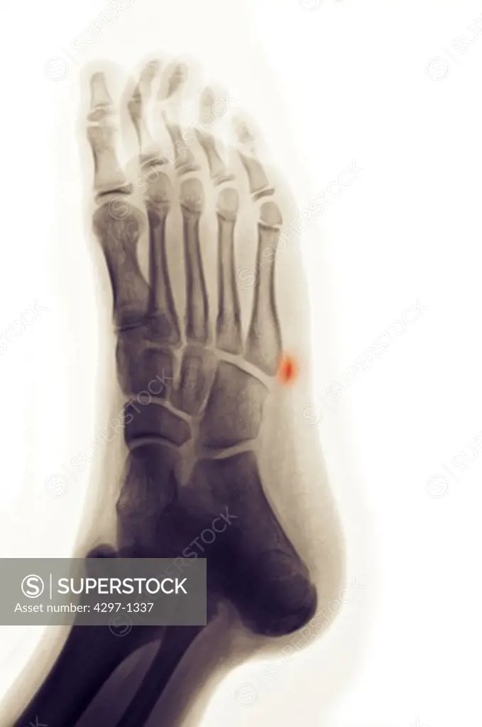Colorized x-ray of an avulsion fracture of the 5th metatarsal of the foot