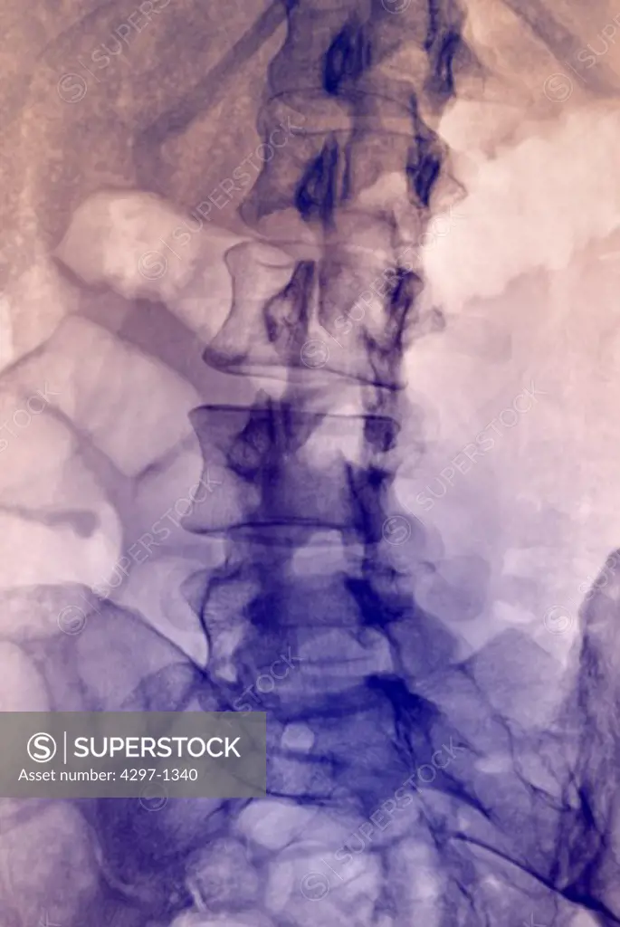 Abdominal x-ray of a 38 year old woman showing the lumbar spine, a portion of the pelvis and ribs