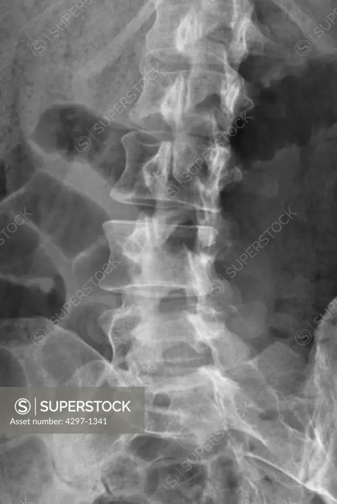 Abdominal x-ray of a 38 year old woman showing the lumbar spine, a portion of the pelvis and ribs