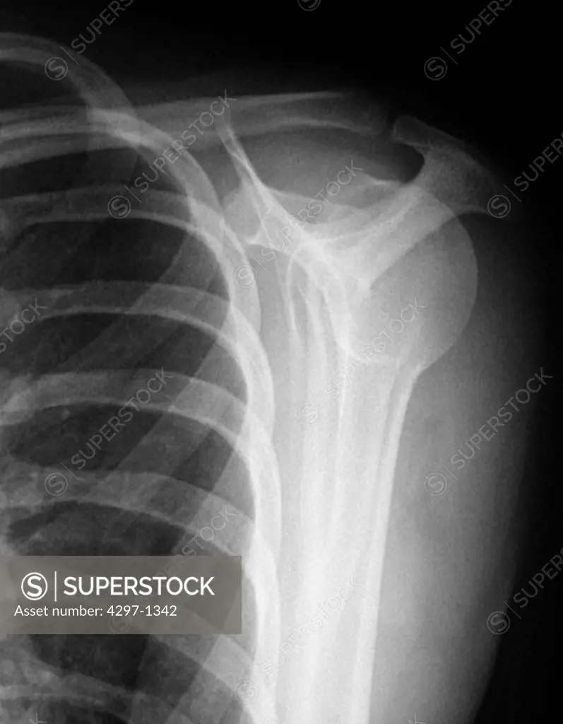normal shoulder x-ray of a 20 year old woman, showing the upper humerus and scapula