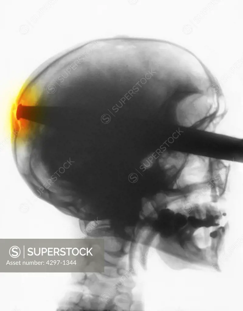 X-ray showing a crowbar embedded in a person's skull