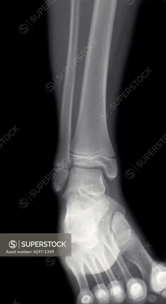 Normal x-ray of the ankle of a 12 year old girl