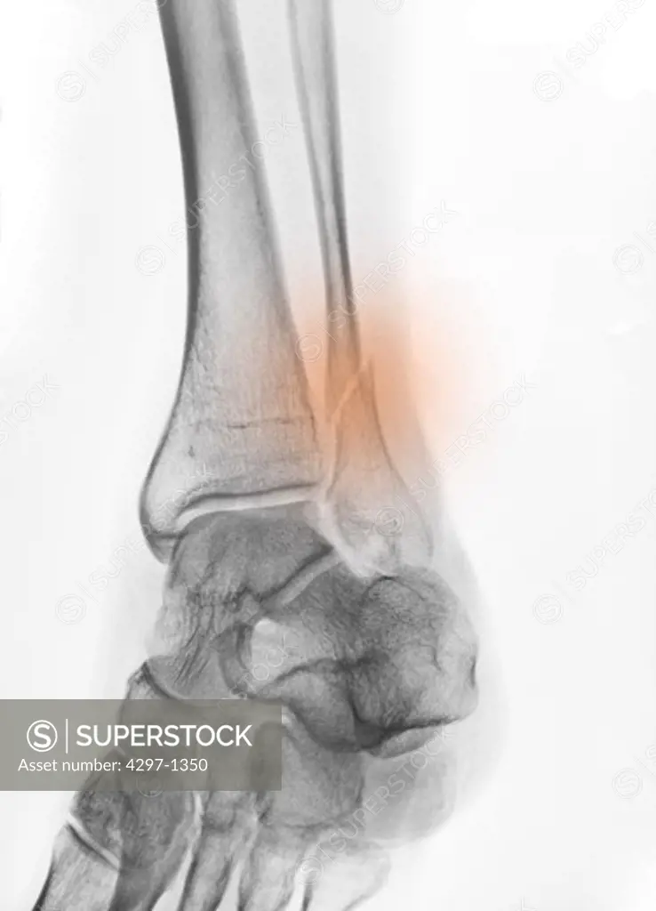 Colorized x-ray of an ankle fracture of the fibula in a 50 year old man