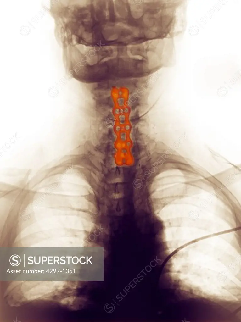Digitally enhanced x-ray of a 57 year old man showing the plates and screws used to fuse the cervical (neck) vertebrae