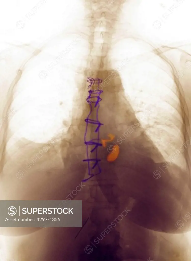 Digitally enhanced colorized chest x-ray of a 63 year old female who had heart surgery with the replacement of 2 heart valves (highlighted orange). Highlighted in violet are the metal wires used by the surgeon to close the thoracic chest wound