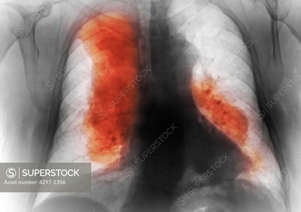 Colorized chest x-ray of a 62 year old man with lymphoma