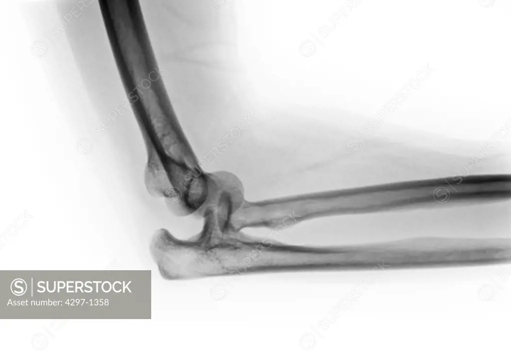 X-ray of a 46 year old woman who dislocated her elbow after a fall