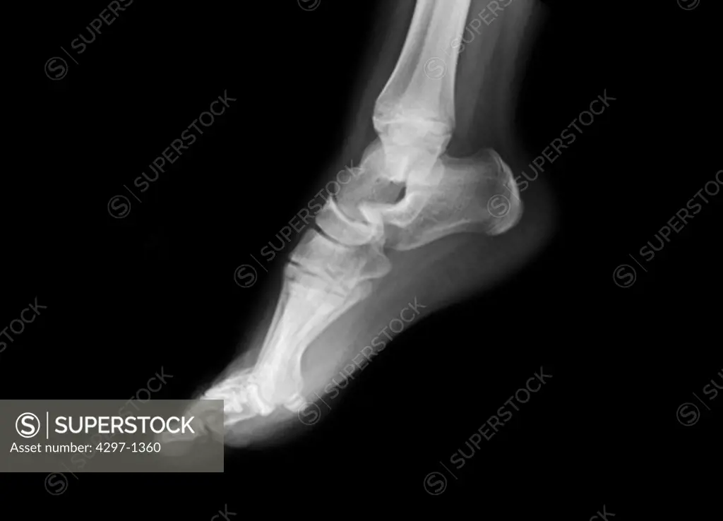Normal foot x-ray of an 11 year old girl