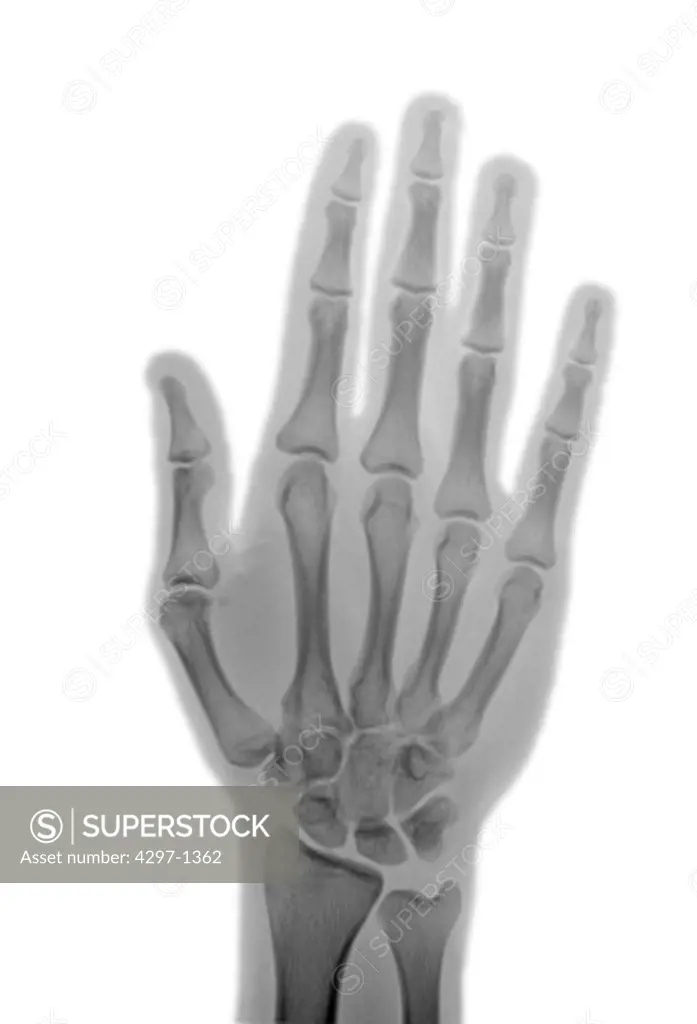 Normal hand x-ray of a 21 year old man