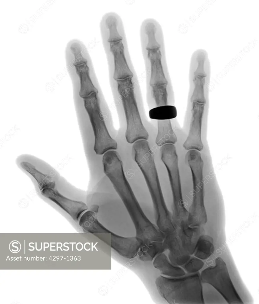 Normal hand x-ray of a 68 year old man who is wearing a wedding ring