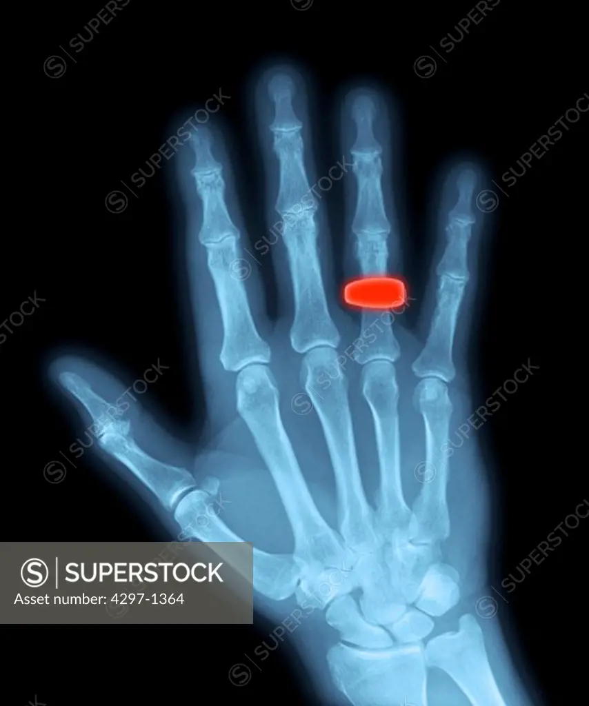 Normal hand x-ray of a 68 year old man who is wearing a wedding ring