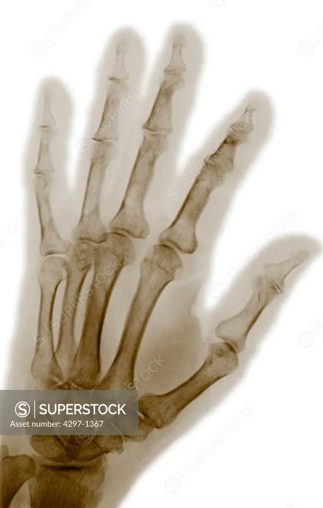 Hand x-ray of a 77 year old woman with osteoporosis