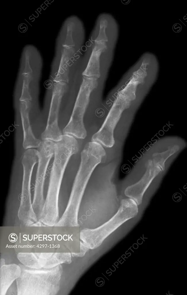 Hand x-ray of a 77 year old woman with osteoporosis