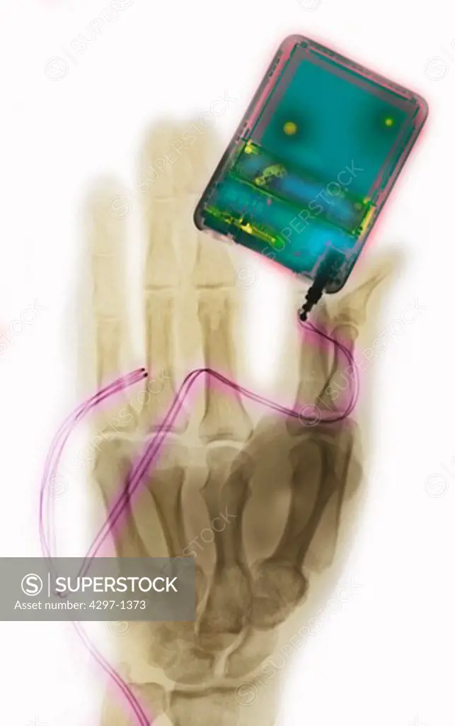 X-ray of a hand holding an iPod