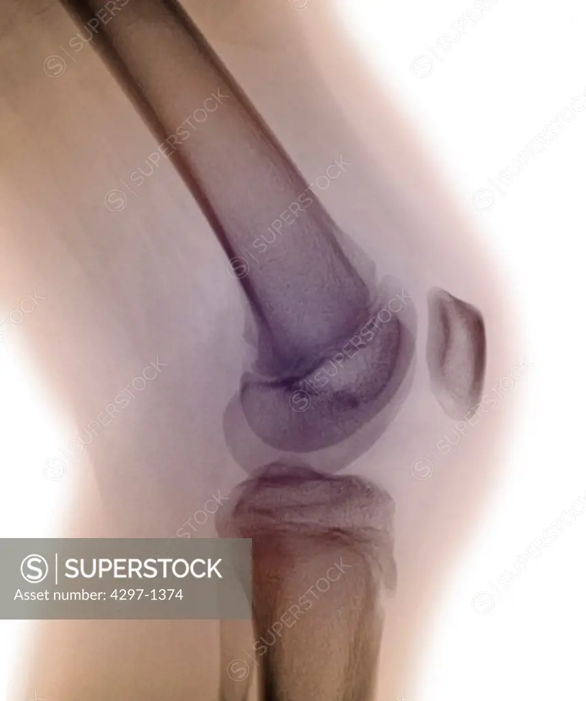 Normal x-ray of the knee of a 13 year old girl