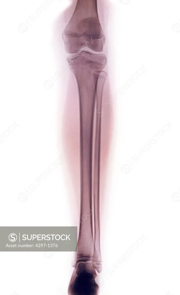 Normal leg x-ray of a 13 year old girl