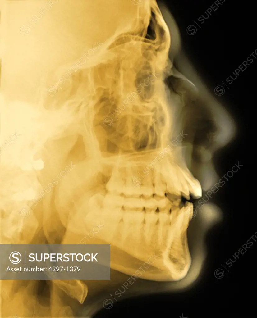 Lateral skull x-ray of a 18 year old man