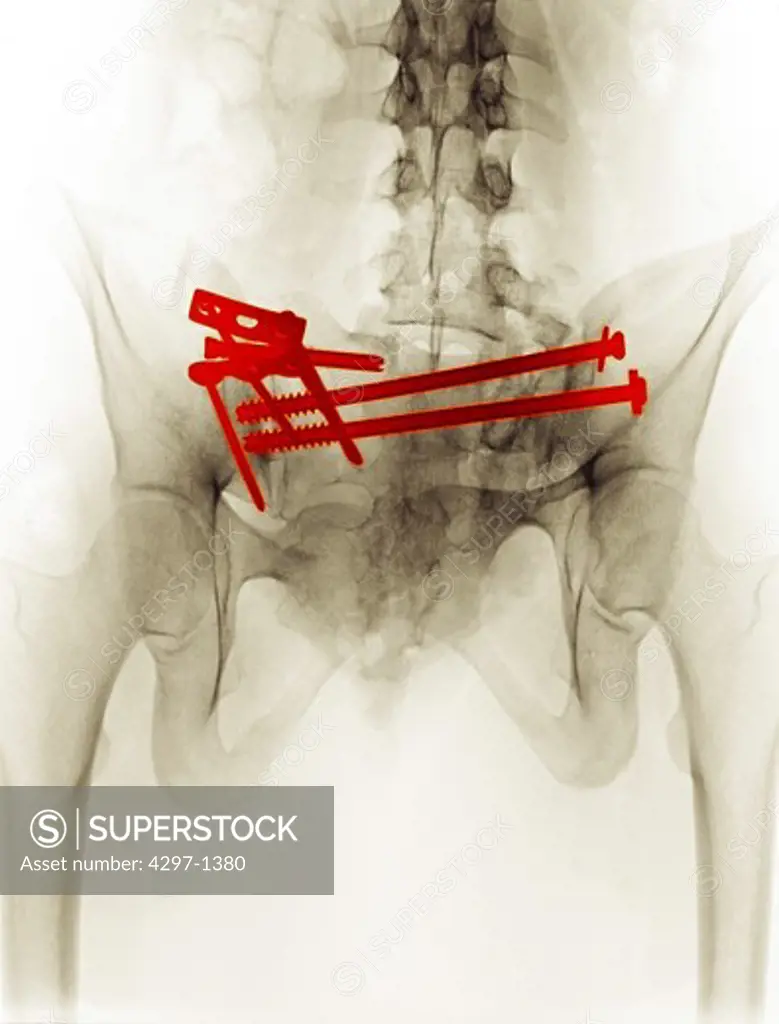 Digitally enhanced colorized x-ray showing the surgical repair of a pelvic fracture of a 21 year old woman involved in a motor vehicle accident