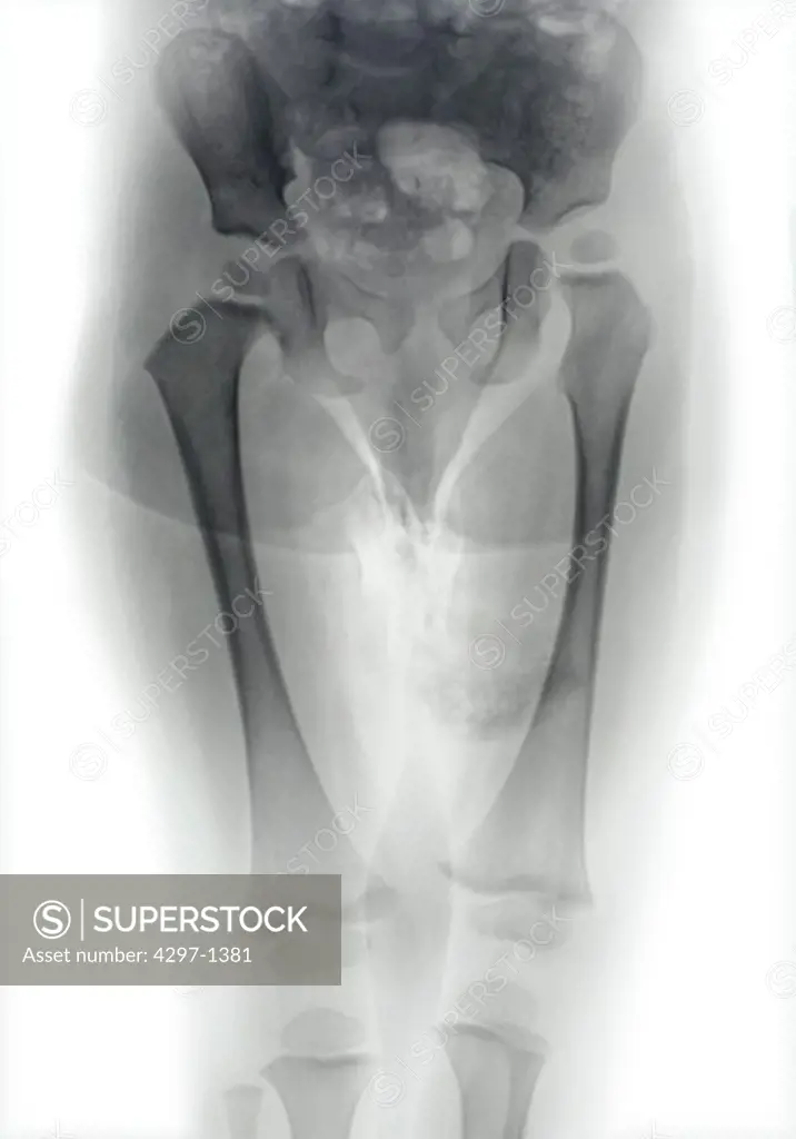 Normal x-ray of the pelvis of a 23 month old boy