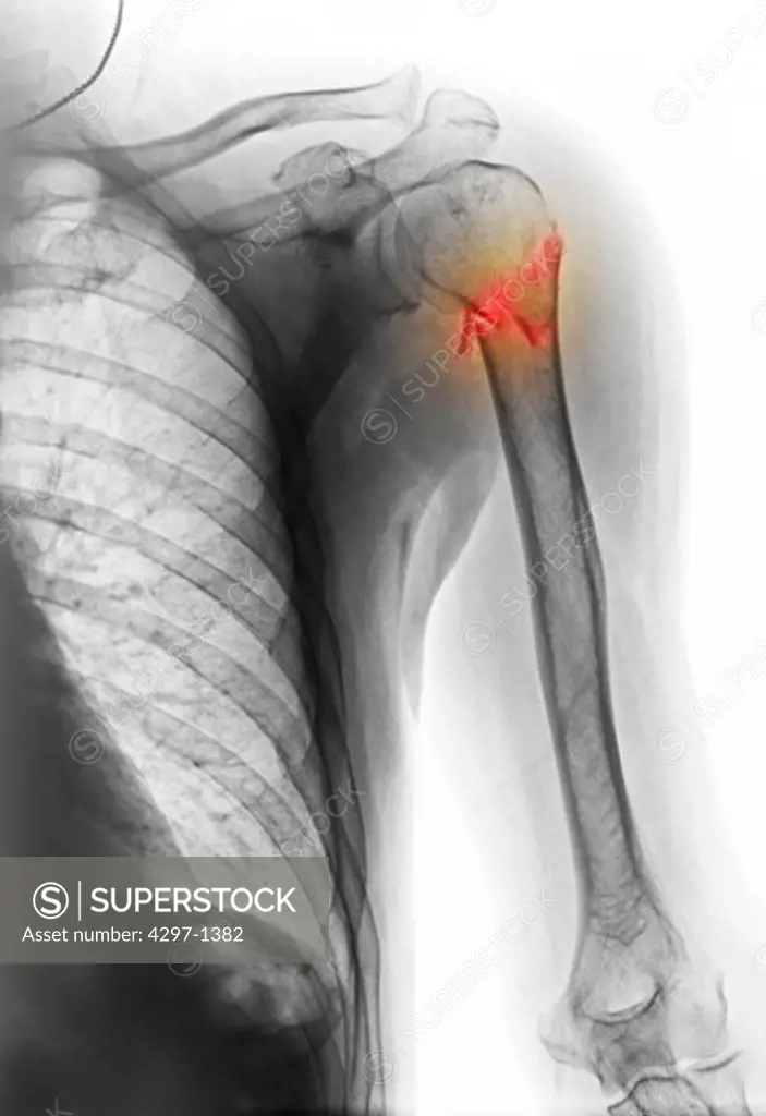 Colorized x-ray showing a fracture of the proximal humerus (upper arm)