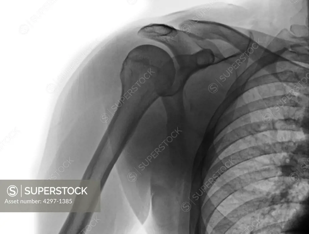 Normal x-ray of the shoulder of a 30 year old man