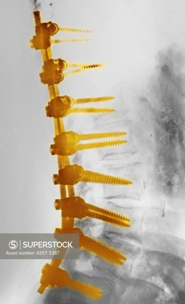 Lumbar spine x-ray of a 73 year old woman who underwent a spinal fusion surgery
