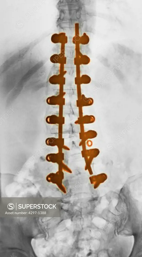 Lumbar spine x-ray of a 73 year old woman who underwent a spinal fusion surgery