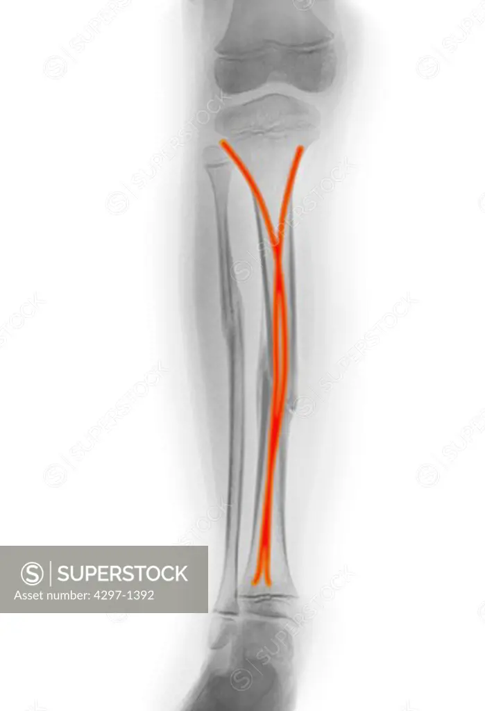 Lower leg x-ray of a 7 year old boy who fractured his tibia and fibula. This is the post-operative x-ray with two rods inserted into the marrow space of the tibia to stabilize the fracture