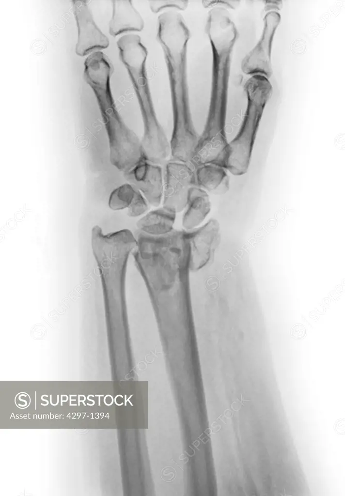 X-ray showing a wrist fracture in a 63 year old woman with osteoporosis