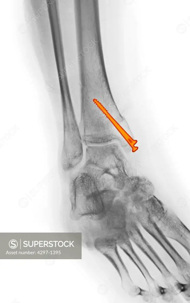 Colorized x-ray of an ankle fracture in a 19 year old woman surgically repaired with two large screws