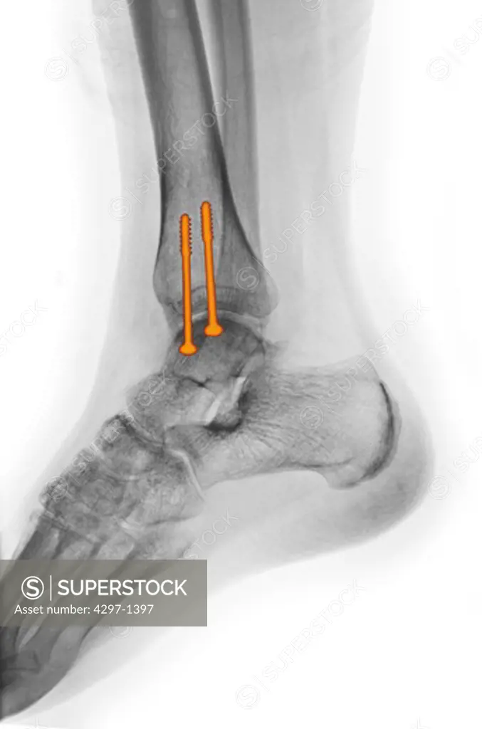 Colorized x-ray of an ankle fracture in a 19 year old woman surgically repaired with two large screws