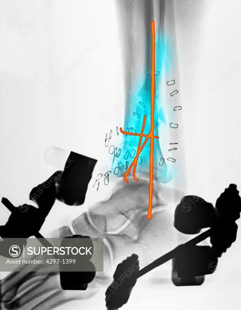 Colorized x-ray of a comminuted fracture of the ankle of a 71 year old man. There are multiple bone fragments (blue), stabilized with internal pins (orange) and an external fixation device