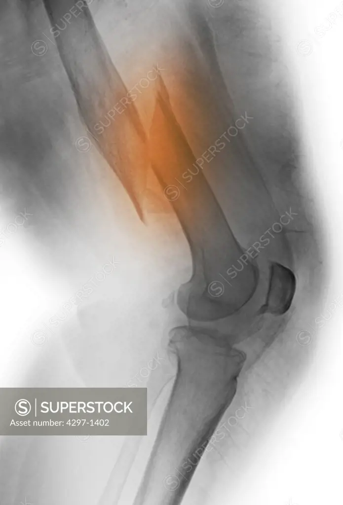Colorized x-ray showing a displaced distal femur fracture in a 67 year old woman with osteoporosis