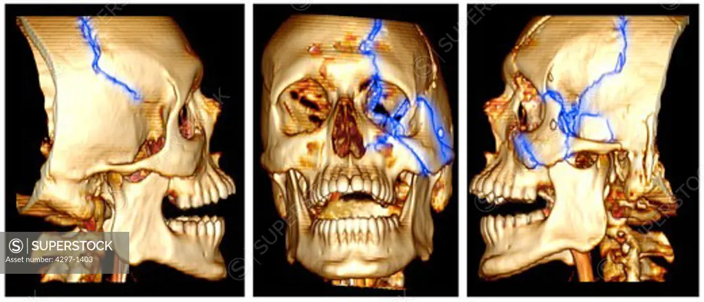 3D CT scan reconstruction showing fractures of the left side of the face and skull of a 24 year old man