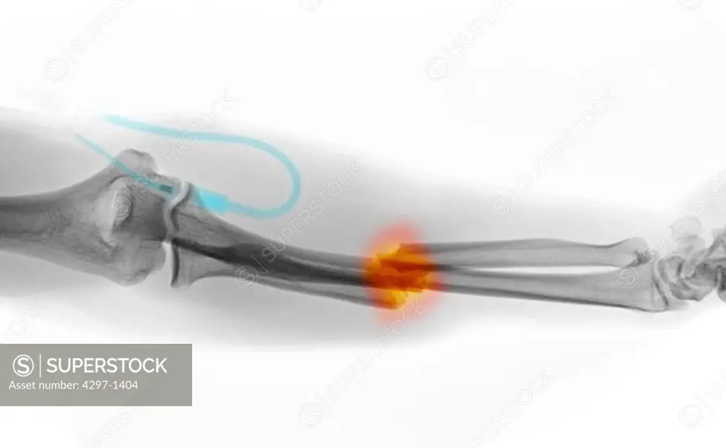 Colorized x-ray of the forearm of a 25 year old man who fractured his ulna and radius