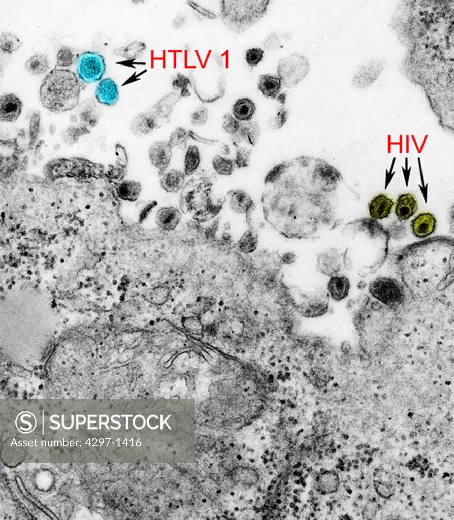 TEM image showing the presence of both the human T-cell leukemia type-1 virus (HTLV-1) and the human immunodeficiency virus (HIV)