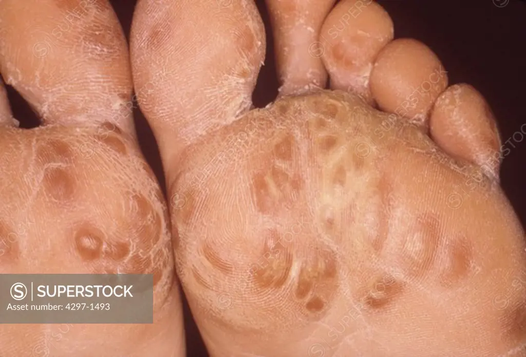 Feet of a patient suffering from Reiter's syndrome, showing a rash called in which small hard nodules develop on the soles of the feet, and less often on the palms of the hands or elsewhere