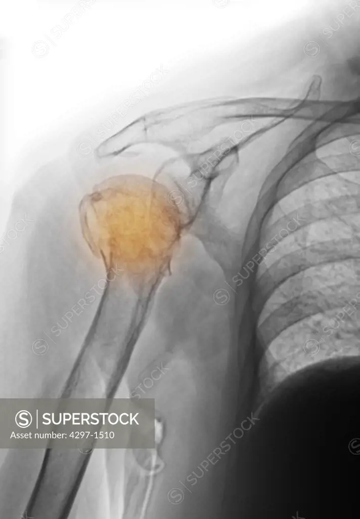 Colorized x-ray of an upper humerus fracture in an 81 year old woman with osteoporosis