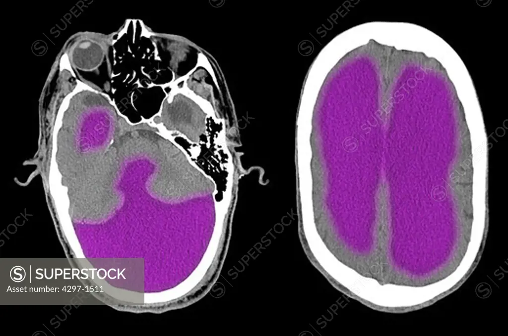 Colorized CT scan images of a 67 year old man with severe hydrocephalus