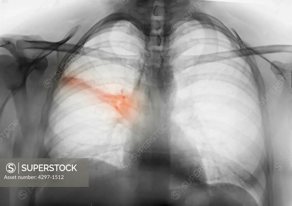 Colorized chest x-ray showing an area of pneumonia in the right lung of a 31 year old man