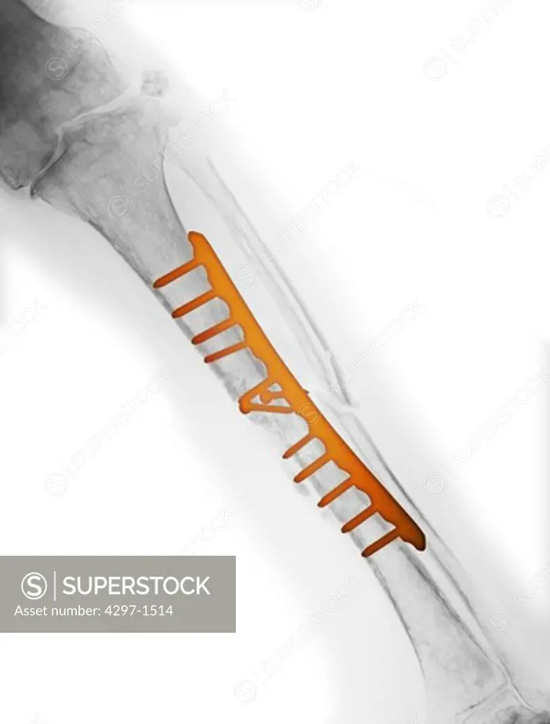 Colorized x-ray of a fracture of the tibia and fibula repaired with a plate and screws
