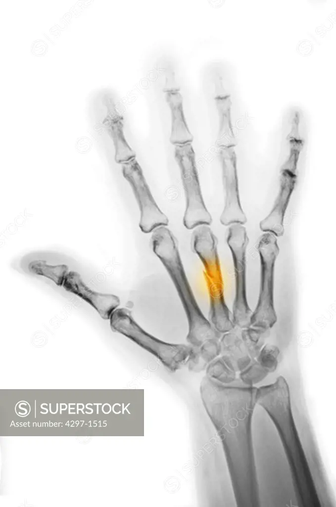 Colorized hand x-ray showing a fracture of the middle metacarpal. A heavy object fell on this man's hand