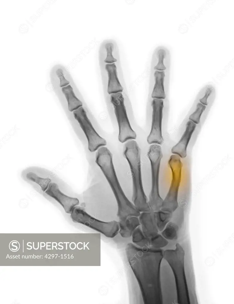 Colorized x-ray of the hand of a 57 year old man showing a healing boxer's fracture. This is a break in the fifth metacarpal caused when the hand punches a hard object, such as a wall