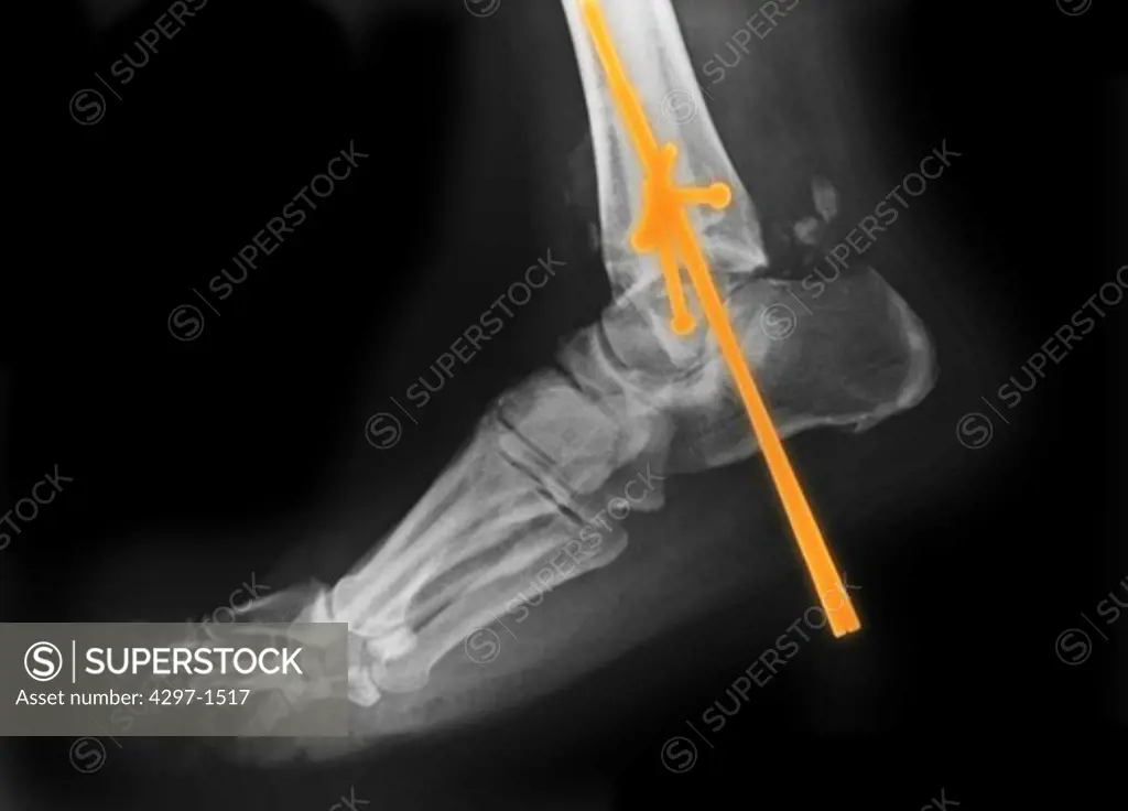 Colorized x-ray showing the surgical repair of an ankle fracture in a 61 year old man