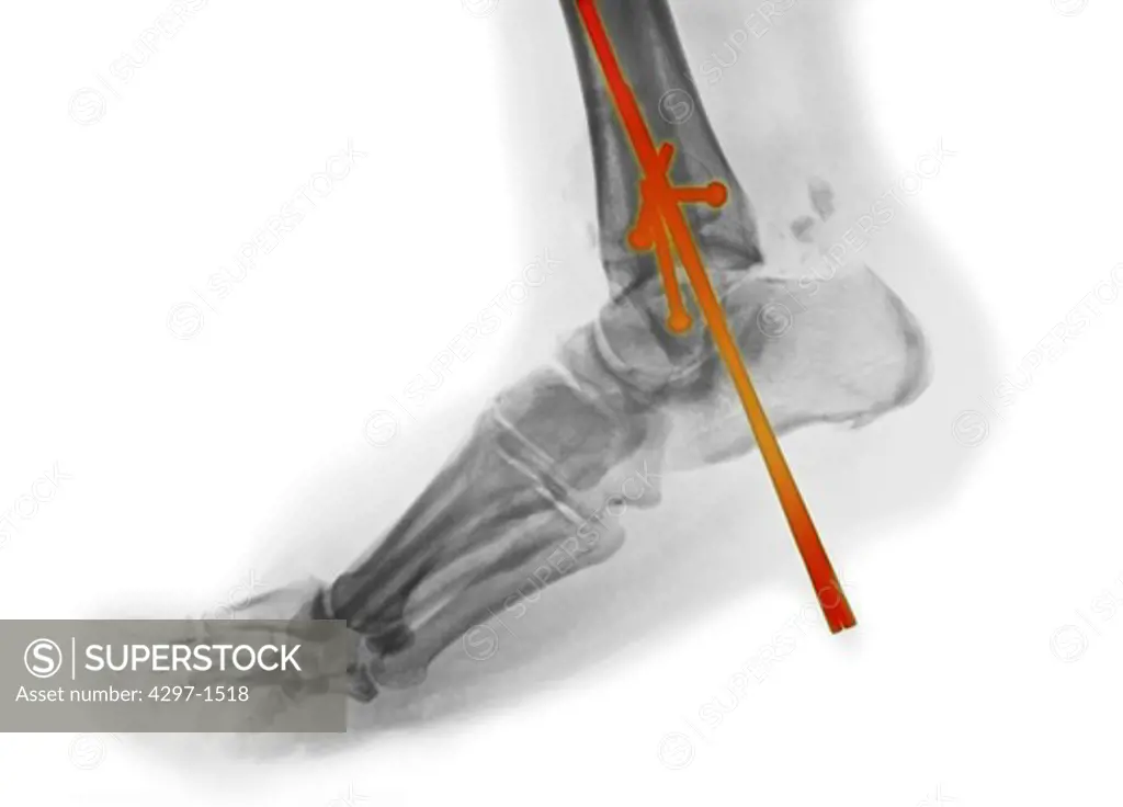 Colorized x-ray showing the surgical repair of an ankle fracture in a 61 year old man