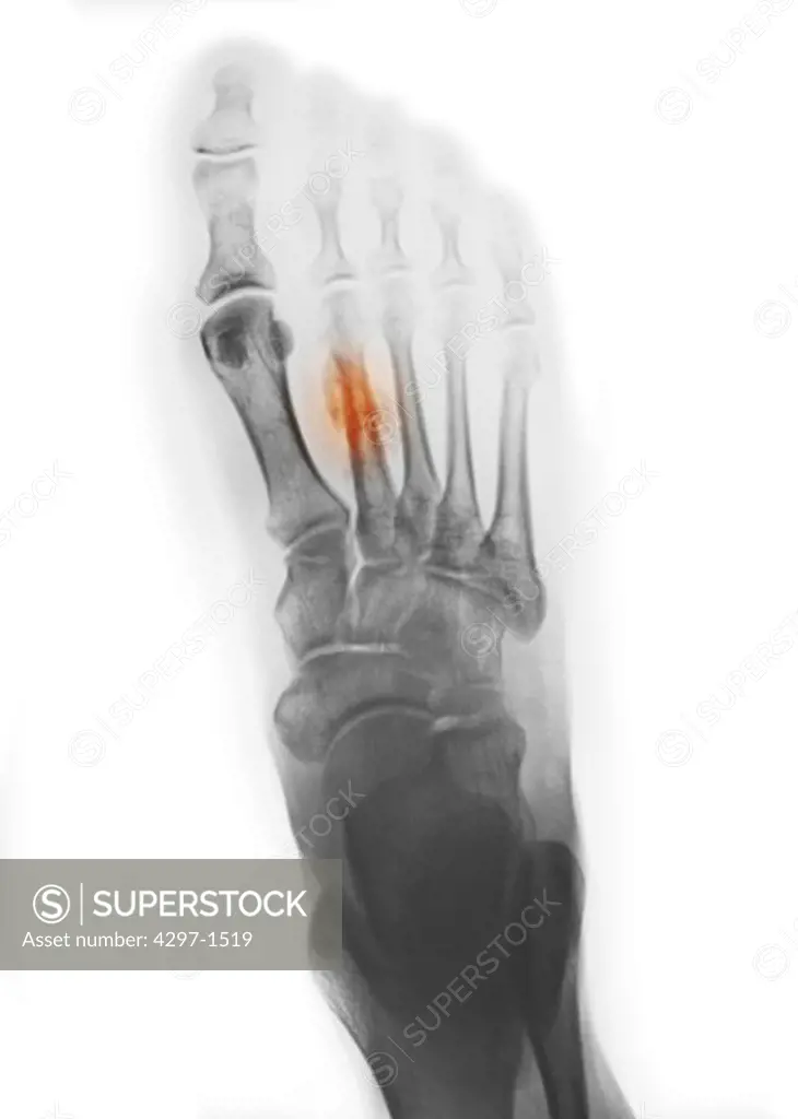 Colorized x-ray showing a healing metatarsal fracture in a 44 year old woman