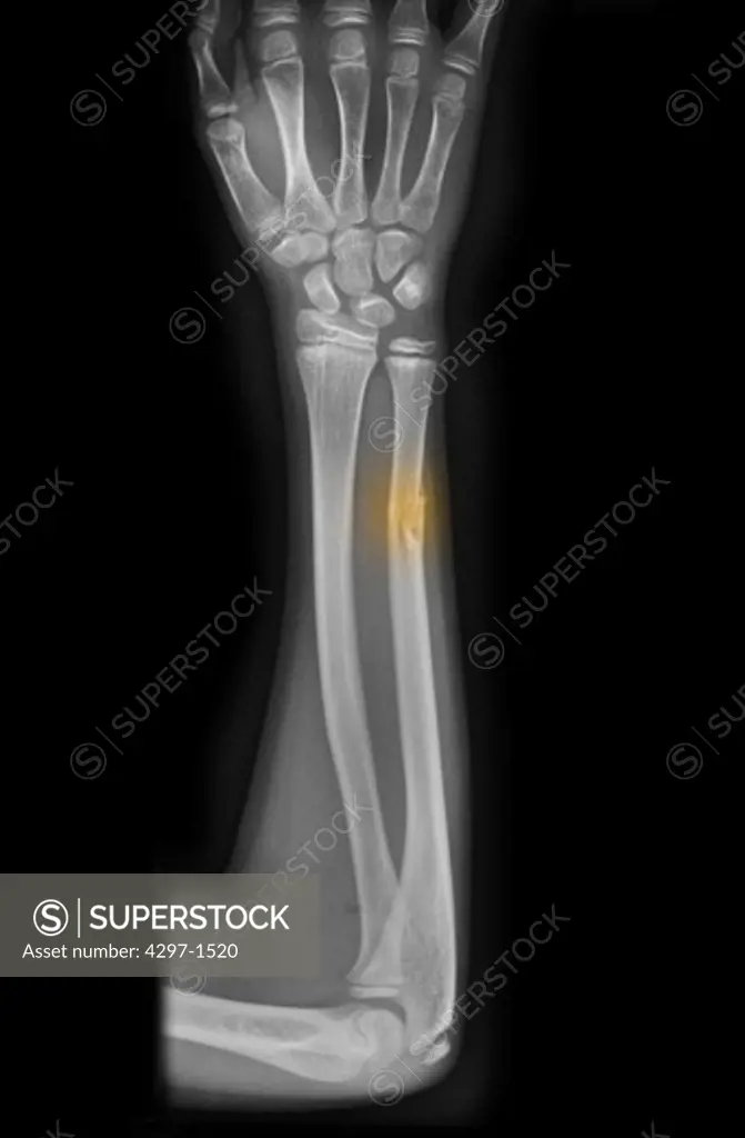 Colorized x-ray of the forearm of a boy with osteogenesis imperfecta who fell and fractured his ulna