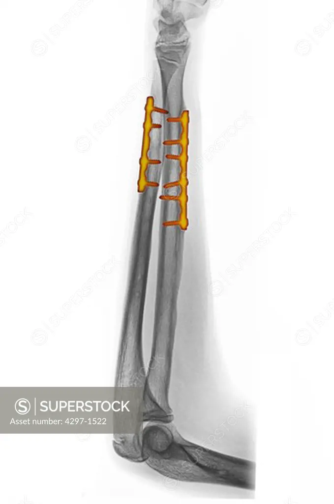 Colorized x-ray of the forearm of a 14 year old boy showing the surgical repair of a fractured ulna and radius