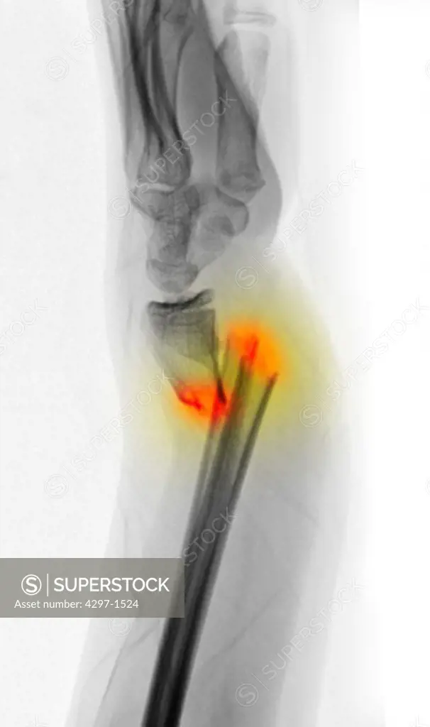 Colorized x-ray showing a severely angulated fracture of the distal radius and ulna in a 12 year old girl